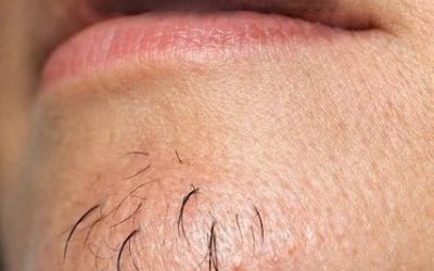 A woman’s chind hair is a sign of…
