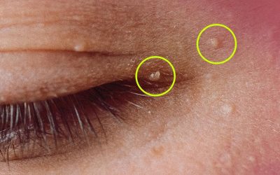 How to Get Rid of Milia: Those Annoying Fat Cysts
