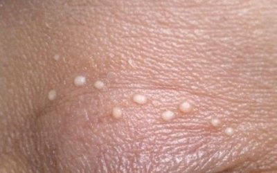 Tiny white bumps keep showing up on my eyelids, and I can’t get in to be seen yet. What are these?