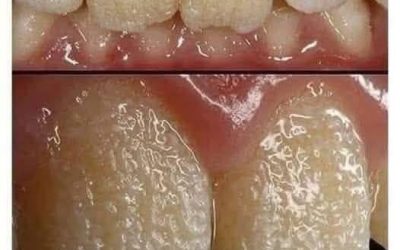 🚨 Be Careful!! This Is What Your Teeth Will Become When You Eat These Everyday Foods